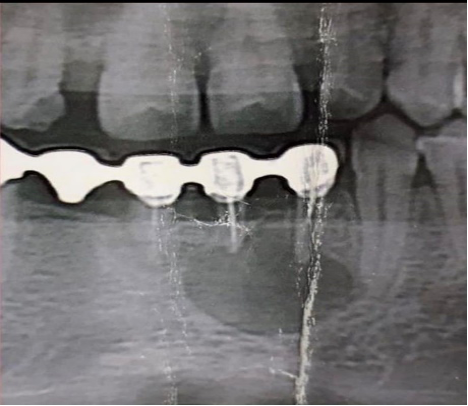 Нагноившийся  радикулярная киста нижней челюсти  в проекции  3.1, 3.2 зубов