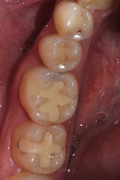вторичный кариес на зубах