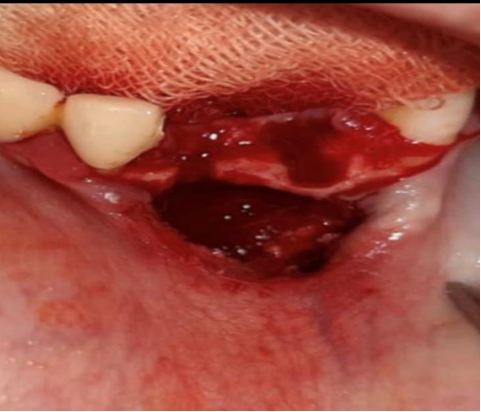 зубы отделены от цельной ортопедической конструкции
