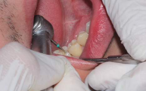 Восстановление зуба техникой прямой художественной реставрации